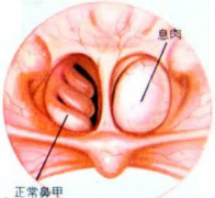 鼻息肉手术费用多少