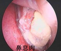 如何判断自己是否得了鼻息肉