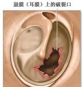 鼓膜穿孔的治疗方法是什么