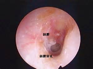 鼓膜穿孔的内窥镜检查症状