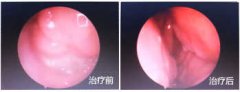 鼻息肉手术后注意事项