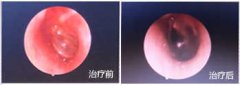 中耳炎怎么治疗