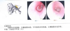 中耳炎如何诊断