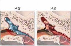 成都哪里医院看中耳炎厉害？
