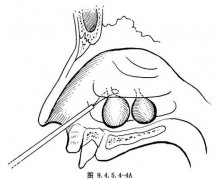 鼻息肉为什么久治不愈
