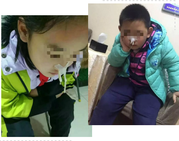 切除腺样体还能治鼻窦炎,这是什么操作?