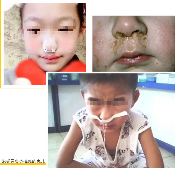 切除腺样体还能治鼻窦炎,这是什么操作?