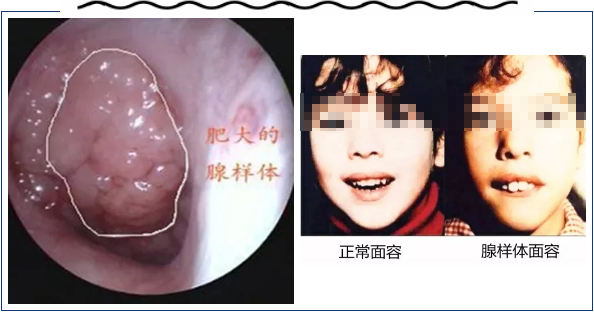 切除腺样体还能治鼻窦炎,这是什么操作?