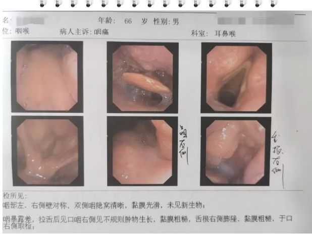 以为是“口腔溃疡”结果是口咽癌? 这台4级高难手术敲响警钟